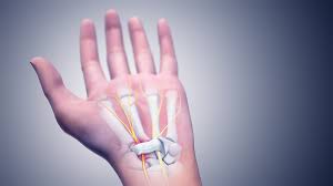 Sindrom Terowongan Karpal (Carpal Tunnel Syndrome)