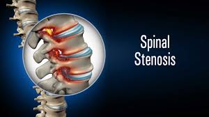 Stenosis Spinal