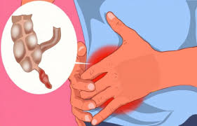 Apendisitis (Radang Usus Buntu)